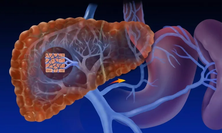 Karaciğer Sirozu ve Komplikasyonları